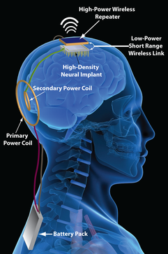 Neural Implants - Human Enhancement: Brain Chips